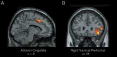 Снимки MRI показывают активизацию ПЦД при эмоциональном расстройстве.