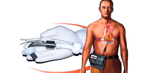 Схема размещения насоса в теле пациента (иллюстрация с сайта micromedtech.ru).