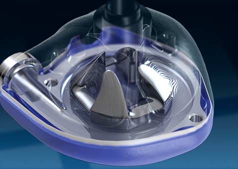 В центре имплантата — ротор из сплава титана (иллюстрация с сайта ventracor.ru).