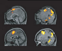 Верхняя пара – снимок мозга растительного пациента во время игры в теннис. Нижняя – снимок мозга добровольца за тем же занятием. Согласитесь, они похожи (иллюстрация Science).