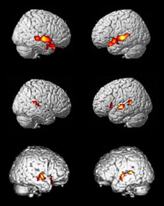 Верхняя пара изображений — мозг здорового волонтёра, слушающего речь. Две пары ниже — образцы растительных пациентов (иллюстрация Adrian Owen)<!-- SP1626D331 -->.