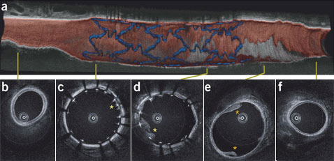 Изображение протезированной коронарной артерии у свиньи, полученное в ходе исследования с помощью OFDI. Крестиками отмечены отложения на внутренней поверхности сосуда (иллюстрация и фото Seok H. Yun et al.)<!-- SP1626D333 -->.