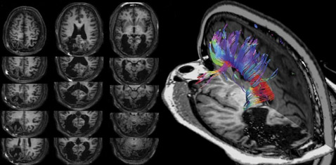 Магнитно-резонансная томография мозга TN подтвердила двухстороннее разрушение визуальной коры (левая группа снимков), но зато показала не вполне обычное распределение волокон в мозолистом теле (справа) (иллюстрация Beatrice de Gelder et.al.)<!-- SP1626D331 -->.