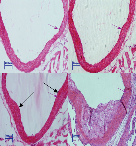 Учёные установили, что на рост давления при заражении цитомегаловирусом атеросклероз (потеря эластичности стенок сосудов) не влияет. Здесь показаны участки стенки аорты: сверху у незаражённых, снизу у больных мышей, при этом фотографии справа получены у мышей, в рацион которых входило большое количество холестерина (фото PLoS Pathogens).
