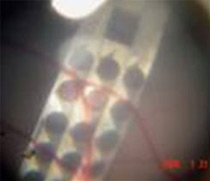 Решётка электродов от BRIP (показана при сильном увеличении), внедрённая в глаз свиньи. Обратите внимание, что чип помещён под сосудистую оболочку глазного яблока – видно, как капилляры проходят поверх чипа (фото Boston Retinal Implant Project).